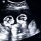 Heboh Foto USG Bayi Kembar Adu Jotos dalam Perut Sang Ibu ..