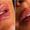 Tren Filler Bibir Keriting Viral di Media Sosial, Aneh atau Unik ..