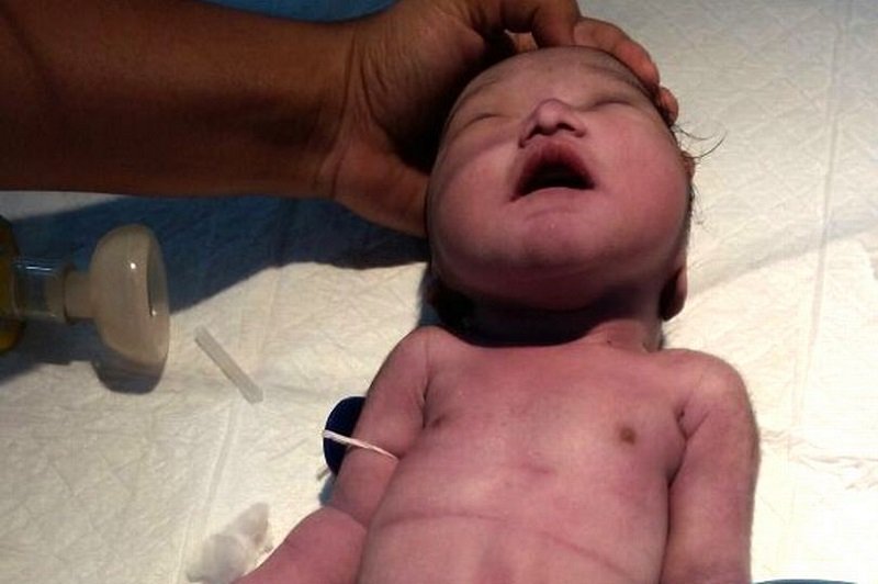 Bukan Dongeng, Kisah Ibu Lahirkan Bayi Mirip Duyung Ini Jadi Viral!