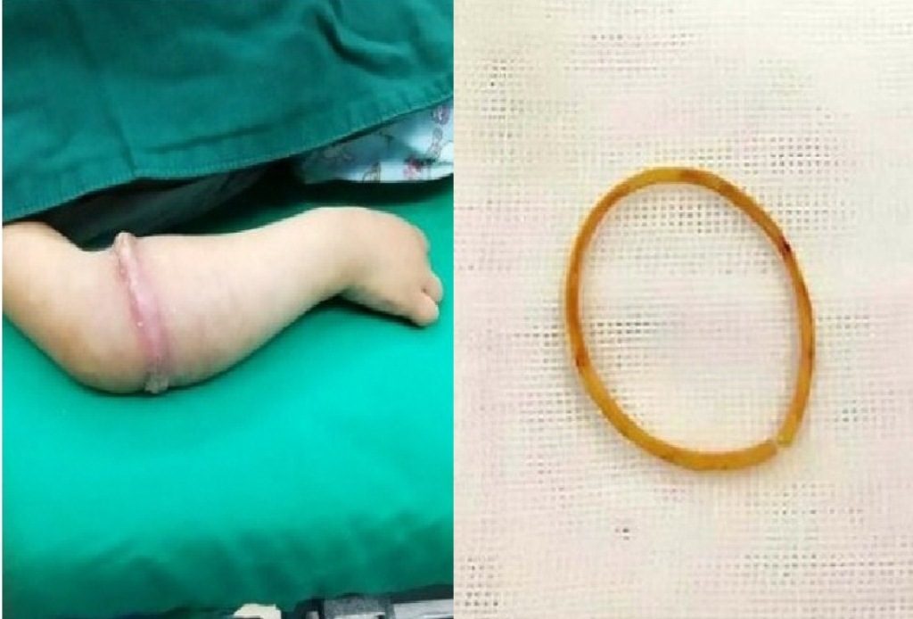 Dipakai Selama 6 Bulan Terus Menerus, Karet Gelang Masuk Ke Dalam Tangan Bocah 4 Tahun Ini