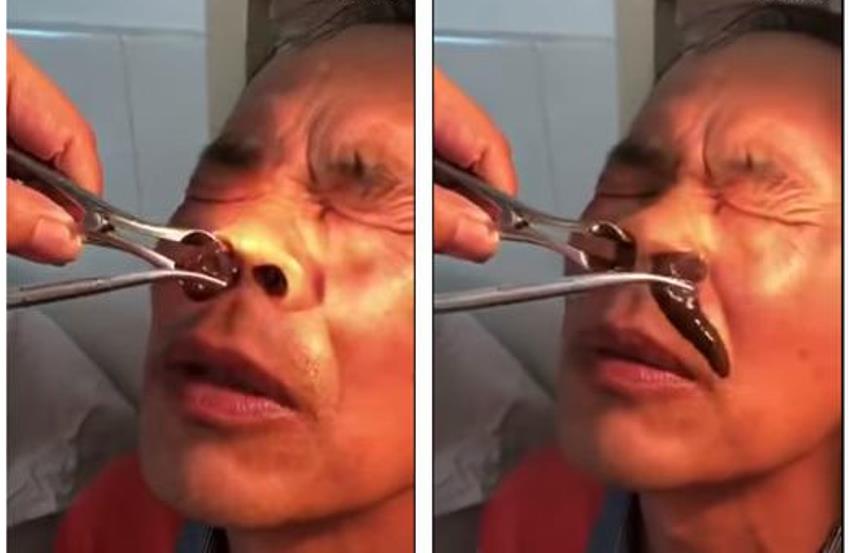 Sering Mimisan, Pria ini Kaget saat Dokter Keluarkan Benda Asing dari Dalam Hidung