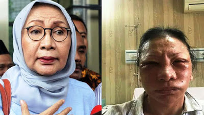 Foto Wajah Bonyok Ratna Sarumpaet Sudah Viral, Netizen: "Dia Bukan Bu Ratna!"