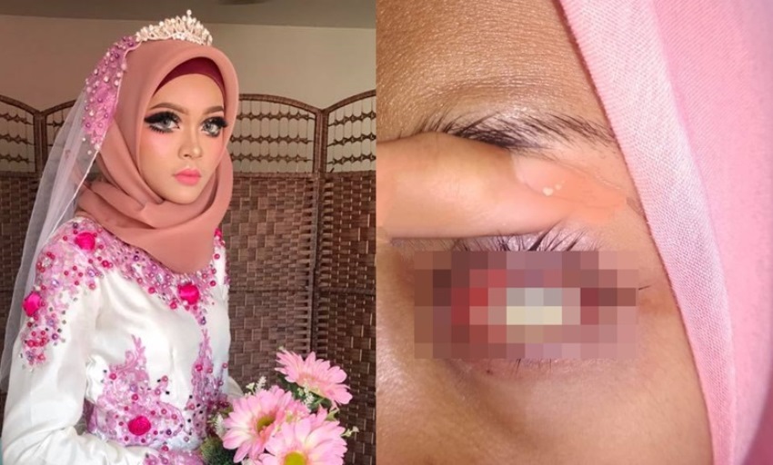 Pakai Softlens Sewaan di Hari Pernikahan, Nasib Pengantin Wanita ini Berakhir Tragis