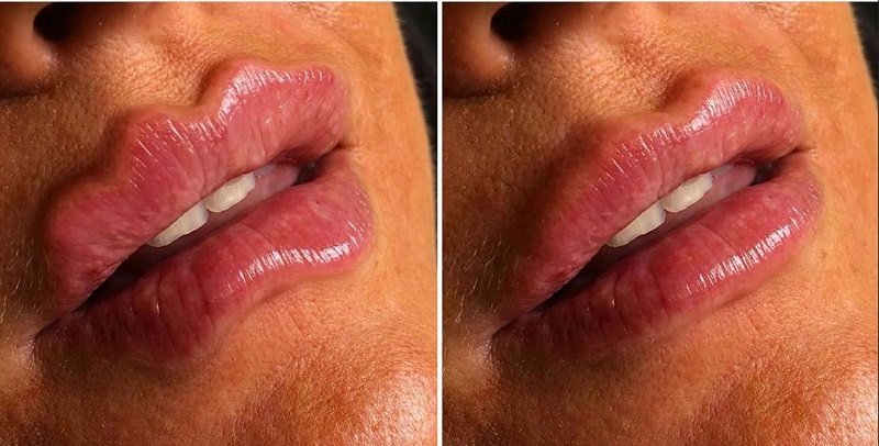800px x 406px - Tren Filler Bibir Keriting Viral di Media Sosial, Aneh atau Unik?